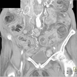 Pseudomembranous Colitis (PMC) - CTisus CT Scan