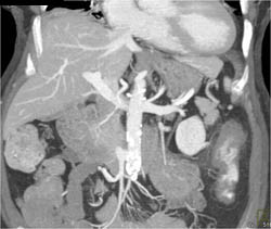 Ulcerative Colitis - CTisus CT Scan