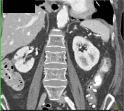 Ulcerative Colitis - CTisus CT Scan