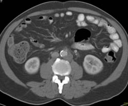 Stranding in Root of Mesentery - CTisus CT Scan