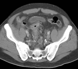 Rectal Cancer With Perineal Inflammation - CTisus CT Scan