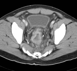 Rectal Cancer - CTisus CT Scan