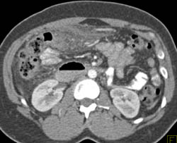 Perforated Transverse Colon Diverticulum With Inflammation in Ruq - CTisus CT Scan