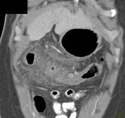 Colitis With Inflammation - CTisus CT Scan