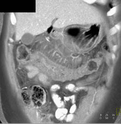 Ulcerative Colitis - CTisus CT Scan