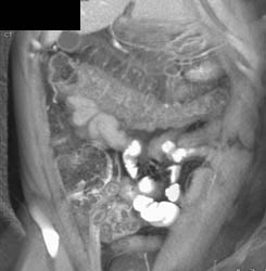 Ulcerative Colitis - CTisus CT Scan