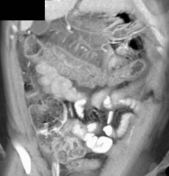 Ulcerative Colitis - CTisus CT Scan