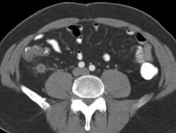 Appendicitis - CTisus CT Scan