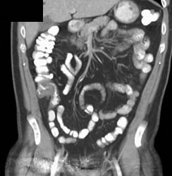 Appendicitis - CTisus CT Scan