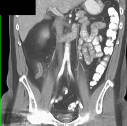 Appendicitis - CTisus CT Scan