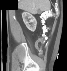 Appendicitis - CTisus CT Scan