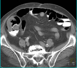 Ischemic Colitis - CTisus CT Scan