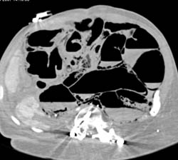 Ischemic Bowel With Pneumatosis and Partial Venous Air - CTisus CT Scan