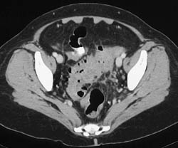 Diverticulitis With Perforation - CTisus CT Scan