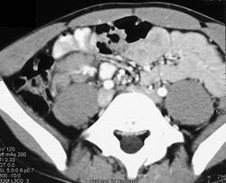 Nodes in Right Lower Quadrant- Mesenteric Adenitis - CTisus CT Scan