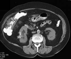 Diverticulitis Right Colon - CTisus CT Scan