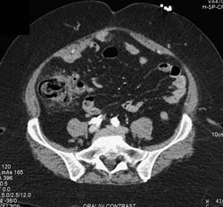 Pneumatosis Coli With Portal Venous Air - CTisus CT Scan