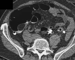 Lipoma Within Cecum - CTisus CT Scan