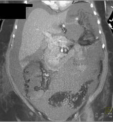 Pneumatosis of the Colon Due to Ischemia With Portal Venous Air - CTisus CT Scan