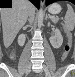 Appendicitis - CTisus CT Scan