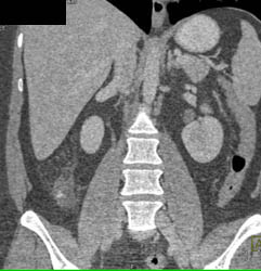 Appendicitis - CTisus CT Scan