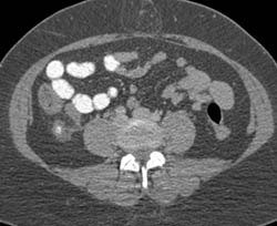 Appendicitis - CTisus CT Scan