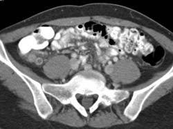 Appendicitis - CTisus CT Scan