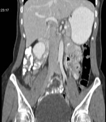 Appendicitis - CTisus CT Scan