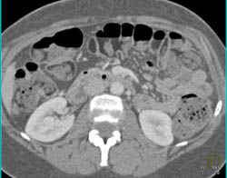 Fat in Colon Due to Ingestion of Lipoid Material - CTisus CT Scan