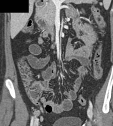 Thickened Right Colon - CTisus CT Scan