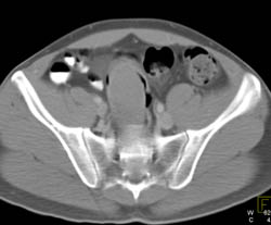 Foreign Body in Rectum - CTisus CT Scan