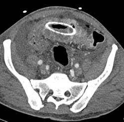 Huge Colon Cancer With Stent in Place and Liver Metastases - CTisus CT Scan