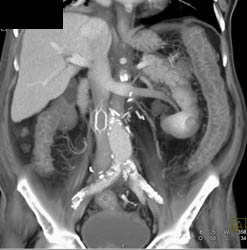 Ischemic Colitis - CTisus CT Scan