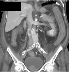 Ischemic Colitis - CTisus CT Scan