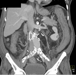 Ischemic Colitis - CTisus CT Scan