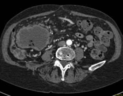 Ascending Colon Carcinoma - CTisus CT Scan