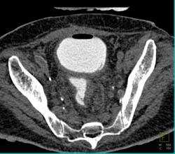 Fistulae From Bladder to Colon - CTisus CT Scan