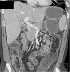 Colitis Left Colon - CTisus CT Scan