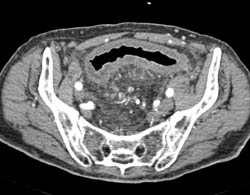 Ischemic Colitis - CTisus CT Scan