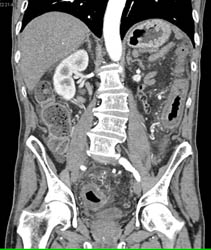 Ischemic Colitis - CTisus CT Scan