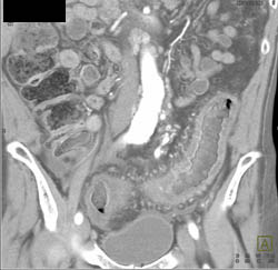 Ischemic Colitis - CTisus CT Scan