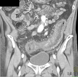 Ischemic Colitis - CTisus CT Scan