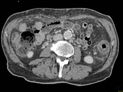 Ischemic Colitis - CTisus CT Scan