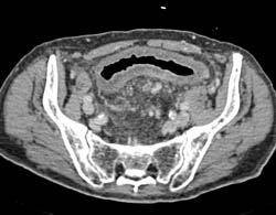 Ischemic Colitis - CTisus CT Scan