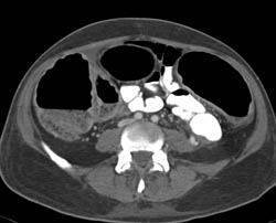 Ulcerative Colitis With Pseudopolyps - CTisus CT Scan