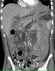 Acute Bleed in Abdomen S/P Colon Resection - CTisus CT Scan