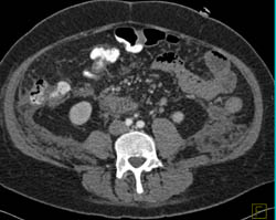 Carcinomatosis - CTisus CT Scan