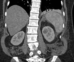 Carcinomatosis - CTisus CT Scan