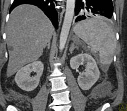 Carcinomatosis - CTisus CT Scan