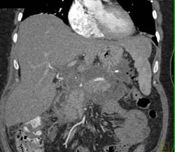 Pancreatitis Involving the Transverse Colon - CTisus CT Scan